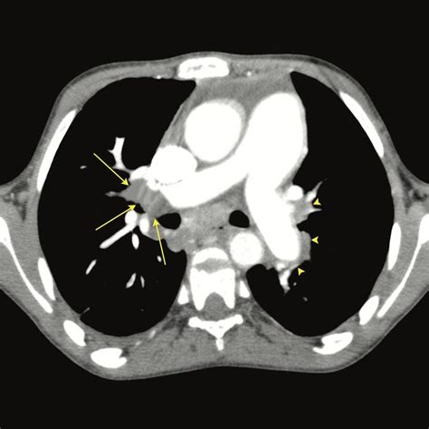 Chest CT Angiography Showing Defects In The Right Long Arrows And