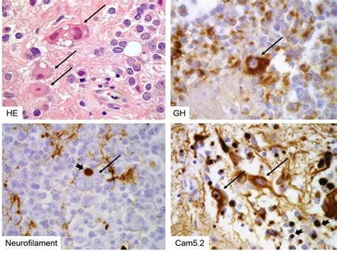 Pathology And Pathogenesis Of Pituitary Adenomas And Other Sellar