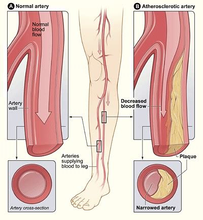 Peripheral Artery Disease - Causes and Risk Factors | NHLBI, NIH