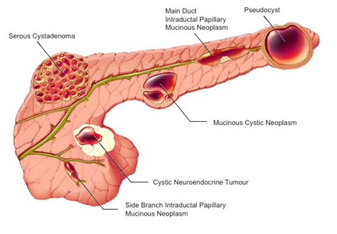 Pancreatic Diseases - General and Hepato-Pancreato-Biliary Surgeon