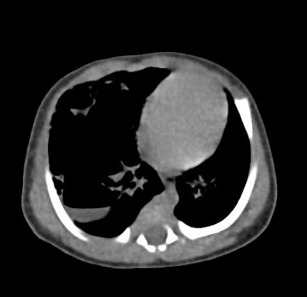 Congenital Pulmonary Airway Malformation CPAM Image Radiopaedia Org