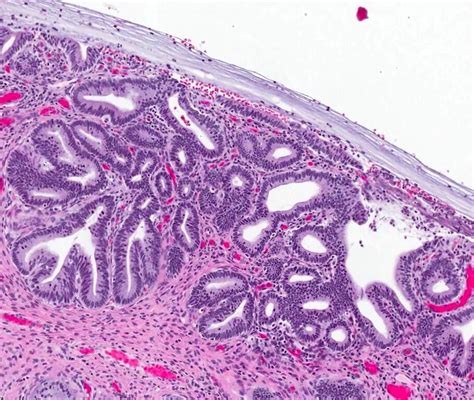 Pathology Outlines Hpv Associated Adenocarcinoma Usual Type And