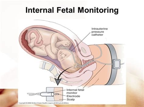 Internal Fetal Monitor Injury Fetal Monitoring Scalp, 49% OFF