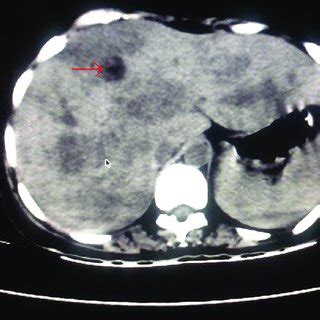 Contrast Enhanced Computed Tomography Abdomen Showing Right Lobe Liver