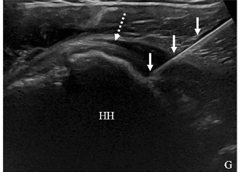 Ultrasound Image Of Glenohumeral Joint Corticosteroid Injection Using Download Scientific