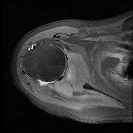 Chondrosarcoma Of The Scapula Radiology Case Radiopaedia Org