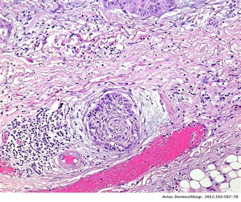 Carcinoma Epidermoide Cutáneo De Alto Riesgo Actas Dermo Sifiliográficas