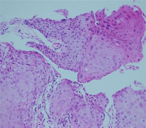 Histopathology Examination Of Perianal Neoplasms Hematoxylineosin