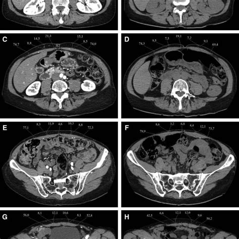 Preoperative Left And Postoperative Right Measurements Of All 4