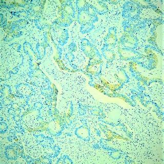 Diffuse CK20 Positive Immunostaining In The Colonic Adenocarcinoma