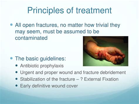 Ppt Open Fractures Principles Of Management Powerpoint Presentation