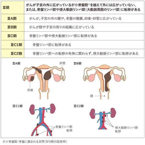 子宮体がん（子宮内膜がん） 治療： 国立がん研究センター がん情報サービス 一般の方へ