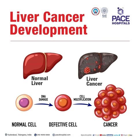 Liver Cancer — Symptoms Risk Factors Complications And Treatment By Pace Hospitals Medium