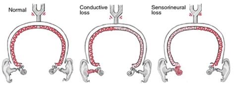 Hearing Loss Flashcards Quizlet