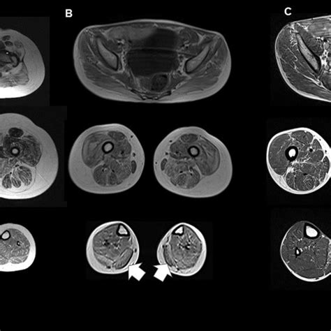 E Muscle Mri T1 Weighted Axial Muscle Mri Slices At Pelvis Thigh And Download Scientific