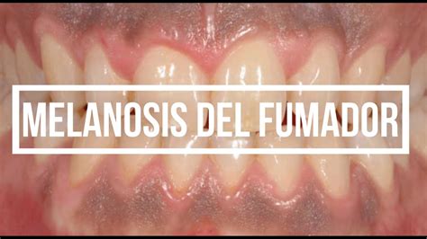 Pigmentación MELÁNICA Oral MELANOSIS del fumador pigmentación racial