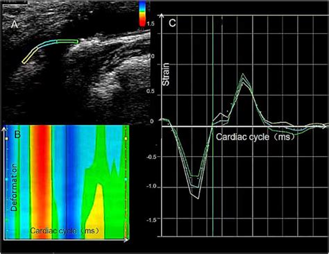 Contrast Enhanced Ultrasound Combined With 2d Strain Imaging And Histopathological Multimodal