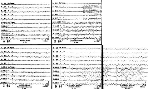 Fentanyl Induced Electrocorticographic Seizures In Patients With