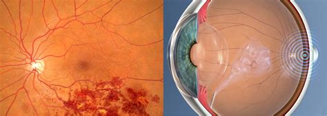 24. Intravitreal injections for retinal vein occlusion - Retina Doctor