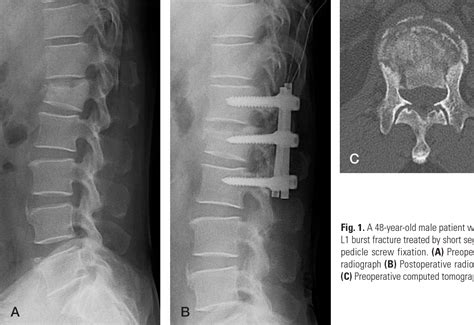 Table 1 From The Outcomes Of Short And Long Segment Posterior