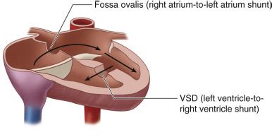 Tricuspid Atresia Types