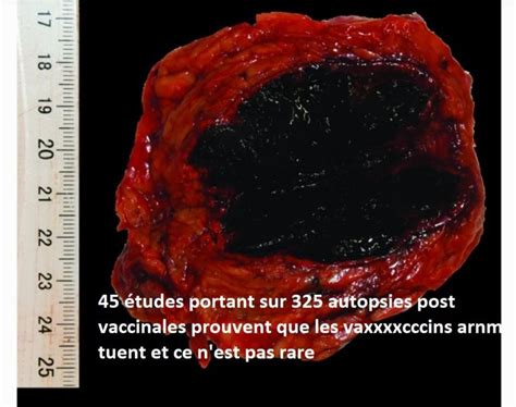 Vérité Diffusée on Twitter DOSSIER VACCIN COVID DÉCÈS LIÉS À L