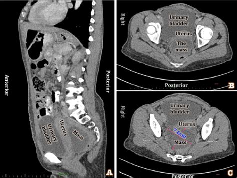 Ct Scan Abdomen Pelvis Anatomy