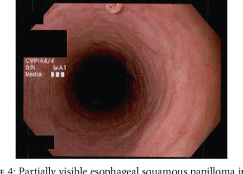 Figure From Squamous Cell Papilloma Of The Esophagus A Case Series