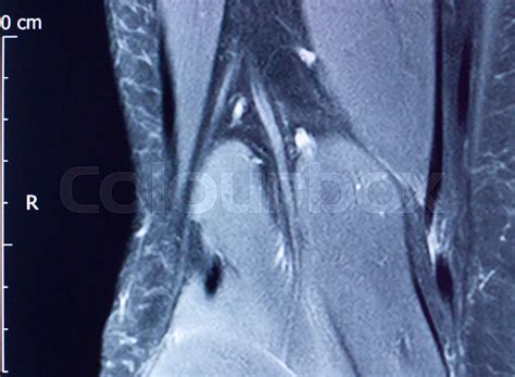 Knee injury mri mcl tear | Stock image | Colourbox