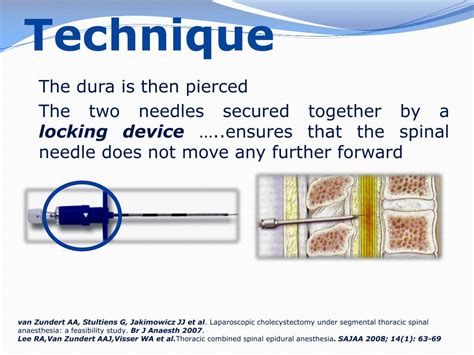 Ppt Segmental Thoracic Spinal Anesthesia Powerpoint Presentation