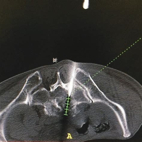 Pdf Initial Ct Guided Percutaneous Biopsy Of Vertebral Lesions