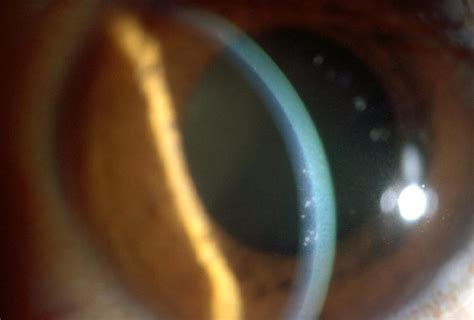 Viral Linked Glaucoma Associated With Corneal Damage Retinal Layer