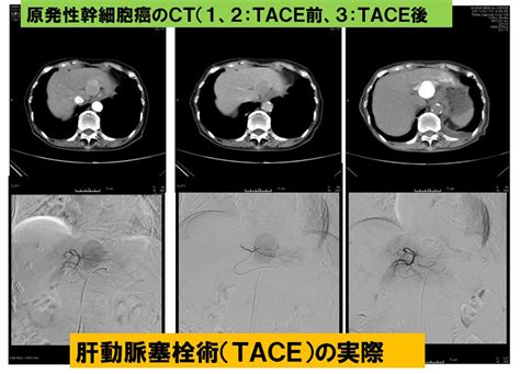 肝疾患の診断と治療｜診療部 消化器内科｜明石医療センター