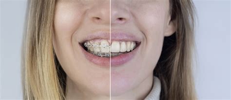 Veneers vs. Braces | Peterson Family Ortho