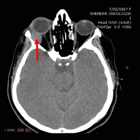 CT Scan Showing An Isodense Lesion At Lateral Part Of Right Orbit