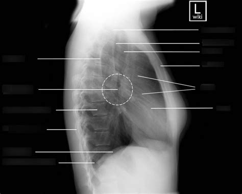 Lateral Cxr Continued Diagram Quizlet