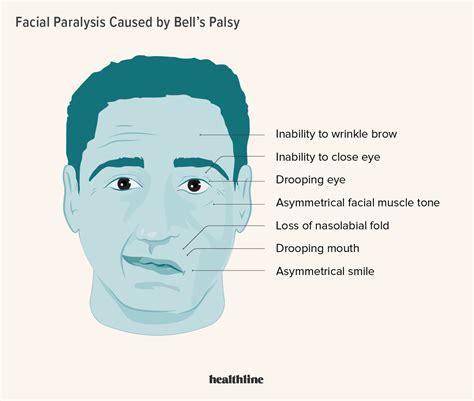 Bell’s Palsy Causes Symptoms Diagnosis Treatment Outlook