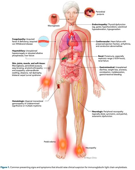 Medclub On Twitter Hematolog A Medicinainterna Signos Y S Ntomas