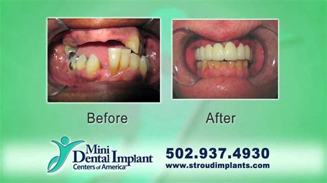 Mini Dental Implants Louisville KY Call 502 937 4930 Implant