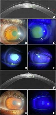 Frontiers Delayed Re Epithelialization After Epithelium Off