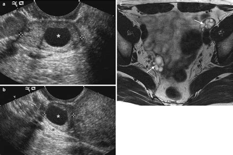 Ovarian Cancer Ultrasound Vs Normal Baby Steps June Ovarian