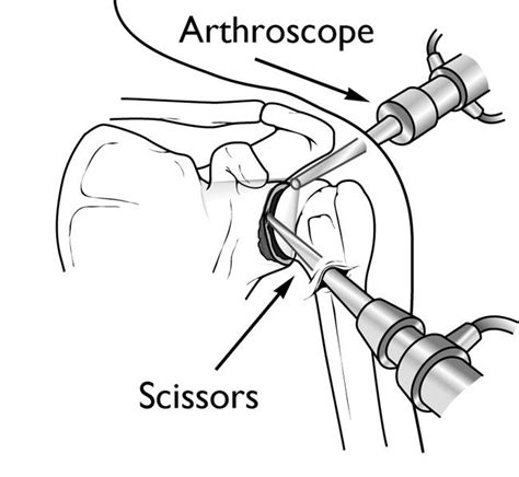 Long Head Of Biceps Pathology At Shoulder Adam Watson Orthopaedic Surgeon