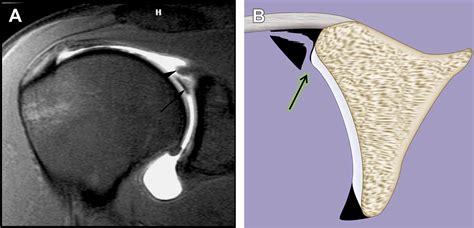 Magnetic Resonance Imaging Of The Glenoid Labrum Radiologic Clinics