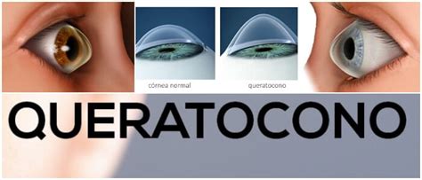 Queratocono Síntomas Causas Diagnóstico Tratamiento Pronóstico y