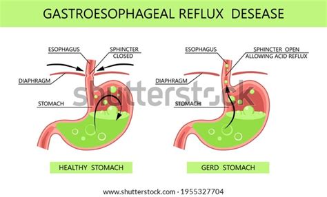 Gastroesophageal Reflux Disease Acid Reflux Heartburn Stock Vector