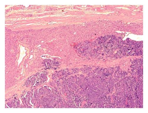 A Within The Encapsulated Follicular Adenoma Is An Abrupt Transition