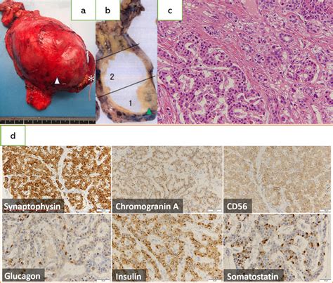 Macroscopic And Microscopic Findings Of A Neuroendocrine Tumor Arising