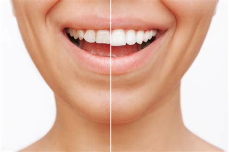 Todo Lo Que Debes Saber Sobre Las Carillas Dentales Cl Nica Dental