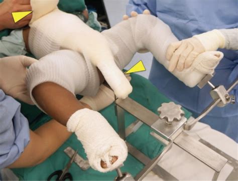 Physical And Clinical Evaluation Of Hip Spica Cast Applied With Three Slab Technique Using