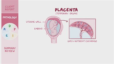 Placental Abruption Nursing Process ADPIE Osmosis Video Library